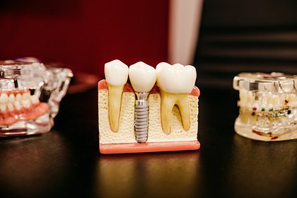 Стоматолог назвал причины для удаления здоровых зубов